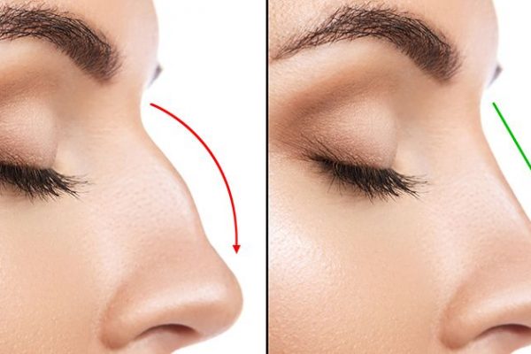 sammenligning fra kvindelige næse efter plastic kirurgi