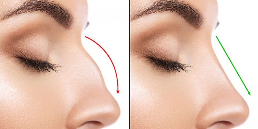 sammenligning fra kvindelige næse efter plastic kirurgi